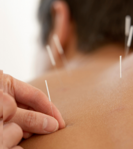 acupuncture